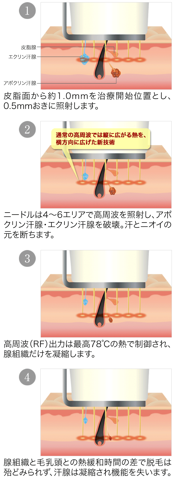 わきが（ワキガ）治療の専門【東京ワキガ多汗治療センター（北村